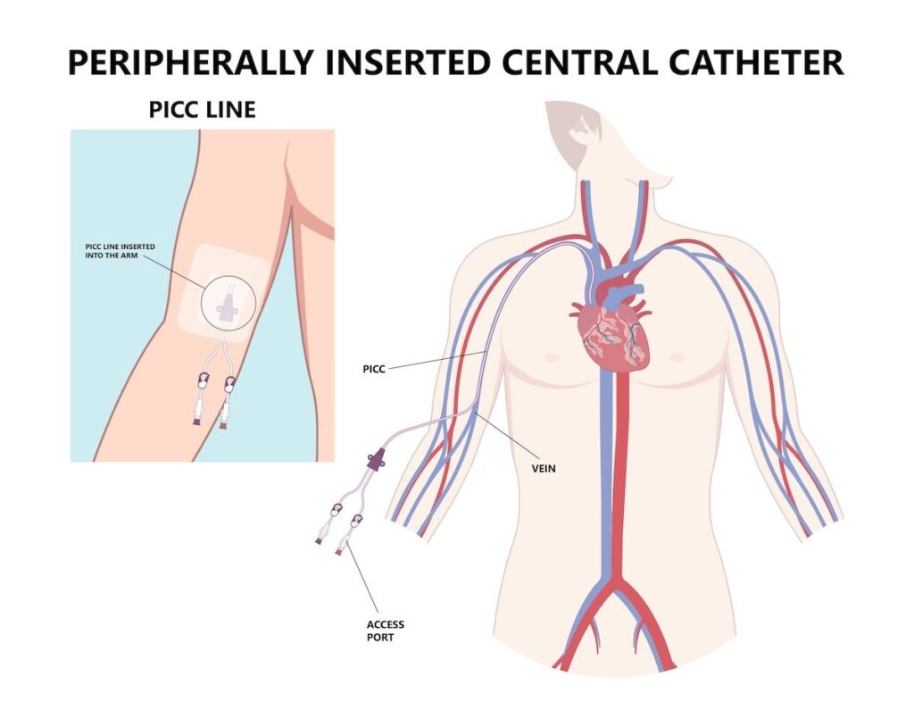 Insertion of a PICC line is done at a hospital's out-patient department (OPD). And, it takes less than a minute to remove it. Insertion of a PICC line is done at a hospital's out-patient department (OPD). And it takes less than a minute to remove it.
