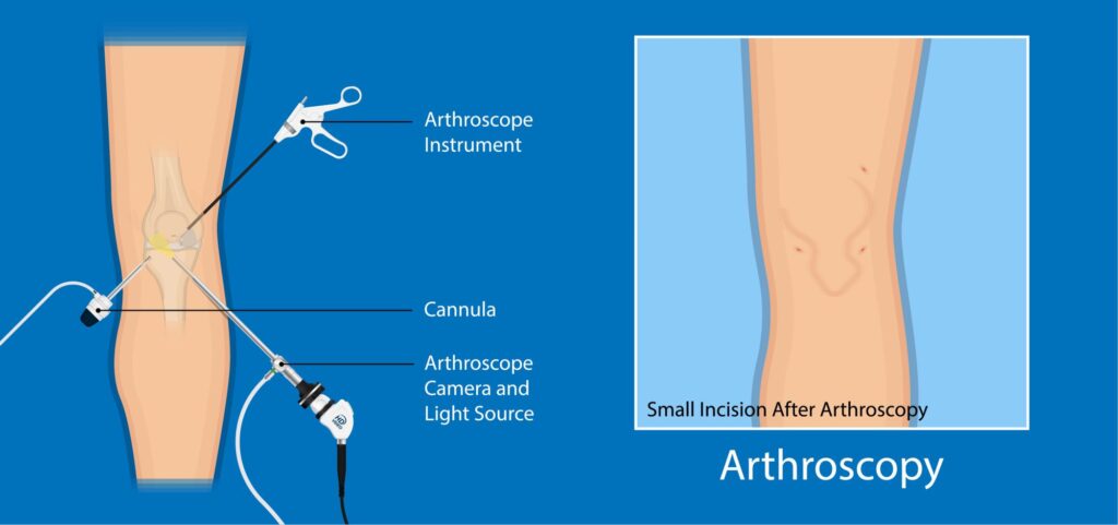 Advanced surgical procedures had made previously long. invasive surgeries like arthroscopic proceduresroutine with high success rates. Advanced surgical procedures had made previously long. invasive surgeries like arthroscopy routine, and with high success rates.